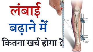 लंबाई बढ़ाने में कितना खर्च होगा? Cost of Limb Lengthening Surgery in India | Increase your Height