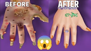 ASMR Hands Treatment | Removal of Maggots Worms and acne Blackhead Pimple |