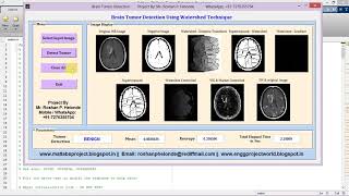 Brain Tumor Detection Using Watershed Technique Full Matlab Project Code