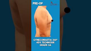 Result of Gynecomastia 360° Technique Surgery | Male Breast Reduction in Delhi