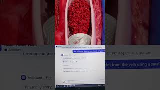 Blood clot removal from the vein using a vacuum cleaner. #doctor #anatomy #zachdfilms #hospital