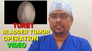 TURBT Transurethral Resection Of Bladder Tumor मूत्राशय का ट्यूमर ऑपरेशन Turbt Surgery Video