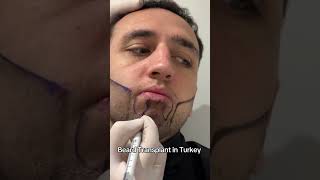 Beard Transplant in Turkey | Beard Transplant Before and After Operation