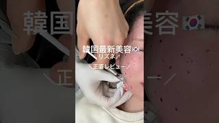 韓国で肌管理🇰🇷💉今話題のリズネ正直レビュー！ダウンタイムはあるけど肌がツヤツヤになりました✨🤍 #韓国旅行 #韓国 #韓国美容#ポテンツァ#リジュラン#リズネ#ララピール#韓国クリニック