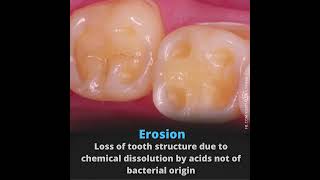 Attrition - Erosion - Abrasion - Abfraction