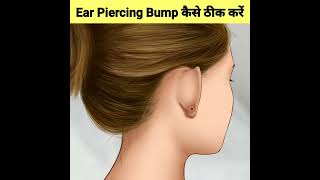 Ear Piercing Bump को कैसे ठीक करते हैं🤔–How to Remove ear piercing bump #shorts