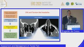 ERS Thessaloniki 2021,Assessment and Management of  Facial Pain, Eugenio de Corso