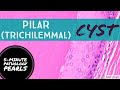 Pilar (Trichilemmal) Cyst 101: 5-Minute Pathology Pearls