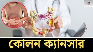 কোলন ক্যানসার | Health | Colon Cancer | Songjukto |