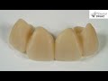 making of natural teeth witn nacera® pearl natural dental direkt india