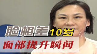 王瑞雪汉传针雕  面部提升瞬间的变化，脸部相差了10岁  美雕 美容针灸 面部提升 私密针灸 中医美容