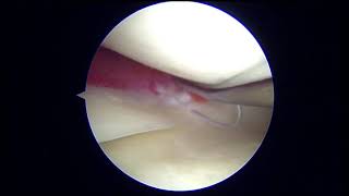 Concurrent Repair of Medial Meniscal Ramp Lesions and Lateral Meniscus Root Tears in Patients Underg