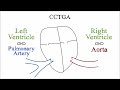 congenitally corrected transposition of the great arteries cctga wth ebstein anomaly left side tv