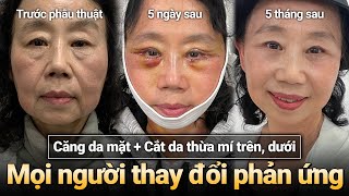 Căng da hiệu quả 10 năm thì 10 sau tôi vẫn muốn làm tiếp l #thammyDM #cangdamat #SMAS #nangcotrerhoa