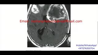 Brain Tumor Classification Using Image Processing | With Source Code | Python Project Code