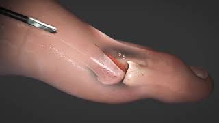 PROStep Minimally Invasive Surgery Bunion Pain: Video 2