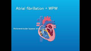 Narrow Complex Tachycardias: Irregular