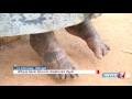 13 year old girl with rare skin disease at ariyalur news7 tamil