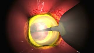 Radiofrequency ablation of the esophagus