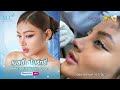 เนสตี้ สไปร์ทซี่ เสิร์ฟลุคใหม่ หลังทำจมูกเทคนิคโอเพ่น slchospital