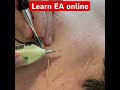 Electroacupuncture for the Levator Scapula