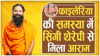 फाइलेरिया (filariasis) की समस्या में सिंगी थेरेपी से मिला आराम || Swami Ramdev