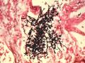 Clinical Mycology: Direct Examination Series: Candida Malassezia [Hot Topic]