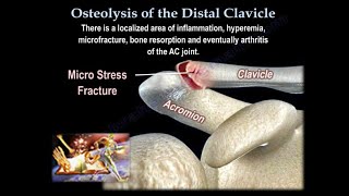 Osteolysis Of The Distal Clavicle - Everything You Need To Know - Dr. Nabil Ebraheim