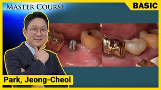 [Master Course Season2 - BASIC] Implant Surgery Complications and Treatments