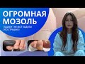 ОГРОМНАЯ МОЗОЛЬ! ПАЦИЕНТ НЕ МОГ ХОДИТЬ! ЭТО СТРАШНО!