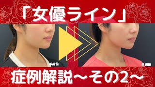 【小顔整形】キレイの秘密！女優ライン、症例解説～その２～どんなに細くてもある二重あごを倒す！【脂肪吸引・スレッドリフト・HIFE・ヒアルロン酸・ボトックス】