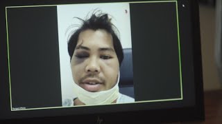 Sacramento activist needs surgeries after being shot with rubber bullets, gas canister during protes