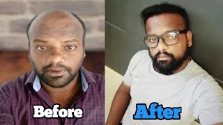 one of the Best Result in Hair Transplant History/வழுக்கை தலை நினைத்து இனி கவலை எதற்கு / chella ht