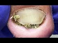 Severe Fungal Infection, Black Mud All Over The Nails, Professional Pedicure【Doctor Liu Pedicure】