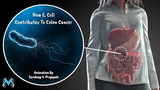 How E. Coli Contributes To Colon Cancer