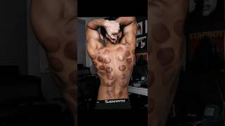 cupping therapy  #shorts #facts #treatment #generalknowledge