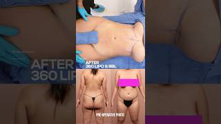Transformation: Stunning Results of 360 Liposuction And Brazilian Butt Lift (bbl)