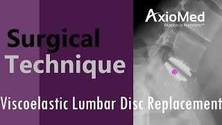 AXIOMED Technique LUMBAR Viscoelastic Disc Replacement by Harvard Surgeon Prof Dr. Kingsley R Chin