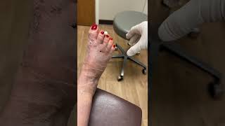 Foot Surgery Journey: Removing K-Wires - A Step Towards Recovery #shorts