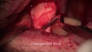 OsteoGen PRF Block