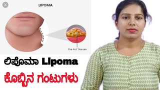 Lipoma ಲಿಪೊಮಾ ಕೊಬ್ಬಿನ ಗಂಟುಗಳು ನಿಮ್ಮ ಕುತ್ತಿಗೆ ಭಾಗದಲ್ಲಿ ಇದ್ದರೆ ಈ ಸರಳ ಮಸಾಜ್ ಮಾಡಿ ನೋಡಿ Neck Lipoma msg