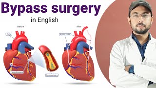 Heart Bypass Surgery  | coronary artery bypass graft (cabg) | heart surgery  | #bypass_surgery