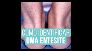 Como identificar ENTESITE ao Ultrassom❓