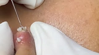 Just the Pops| HUGE nose pops