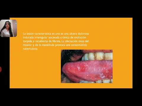 Enfermedades Bacterianas Con Manifestaciones Bucales - YouTube