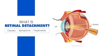 What is Retinal Detachment (Detached Retina)? Causes, Symptoms, and Treatment Options