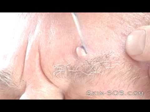 Wart - Warts Removed in 15 Minutes Wart - Warts Removed in 15 Minutes