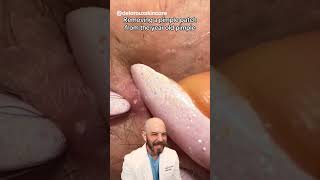 Removing a year old pimple patch👀? (credit:delarouxskincare on TT) #pimple #satisfying #dermatology