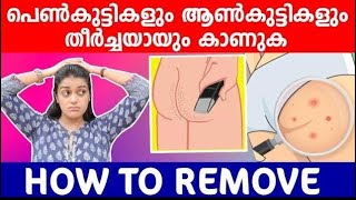 How to remove body \u0026 butt acne scars🙄കുഞ്ഞി കുരുക്കൾ കാരണവും പരിഹാരവും💯|Body Hygiene tips💯