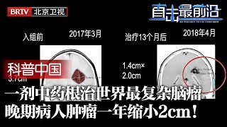 一剂中药根治世界最复杂脑瘤！中国首次发现玉兰草药杀死肿瘤干细胞，改良赠送澳大利亚，竟让复发患者肿瘤缩小2cm！给全球带来新希望【科普中国直击最前沿】